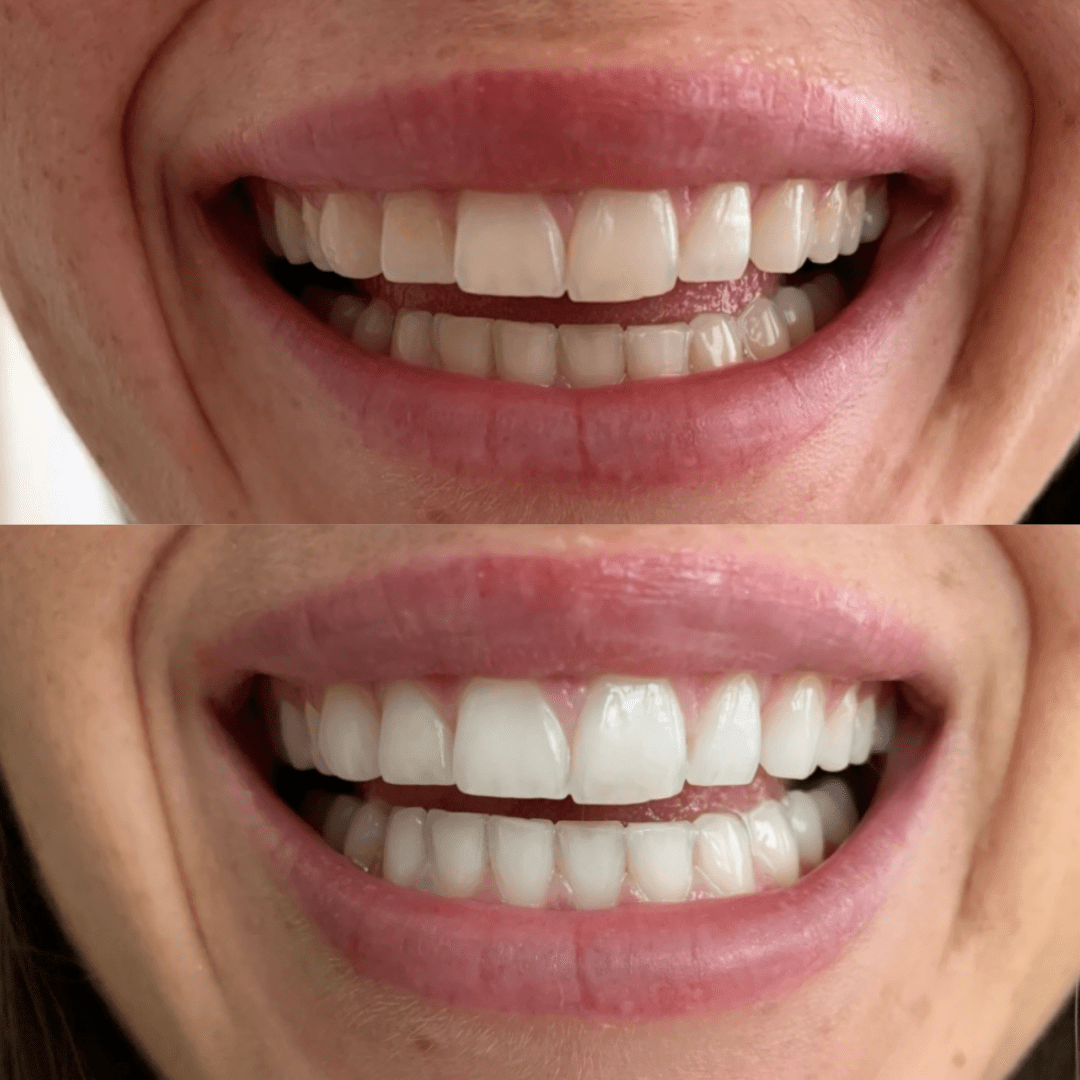 Gem Health & Beauty Gem Whitening Pen Coconut Mint (Whitens Enamel) 4ml