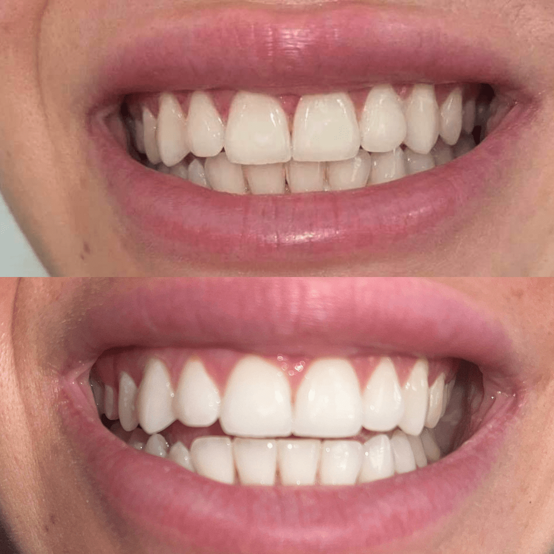 Gem Health & Beauty Gem Whitening Pen Coconut Mint (Whitens Enamel) 4ml