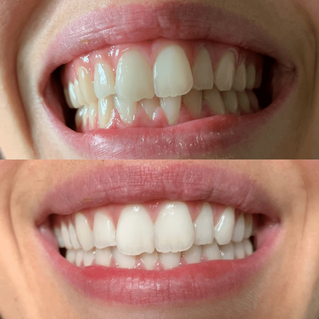 Gem Health & Beauty Gem Whitening Pen Crisp Mint (Whitens Enamel) 4ml