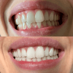 Gem Health & Beauty Gem Whitening Pen Crisp Mint (Whitens Enamel) 4ml